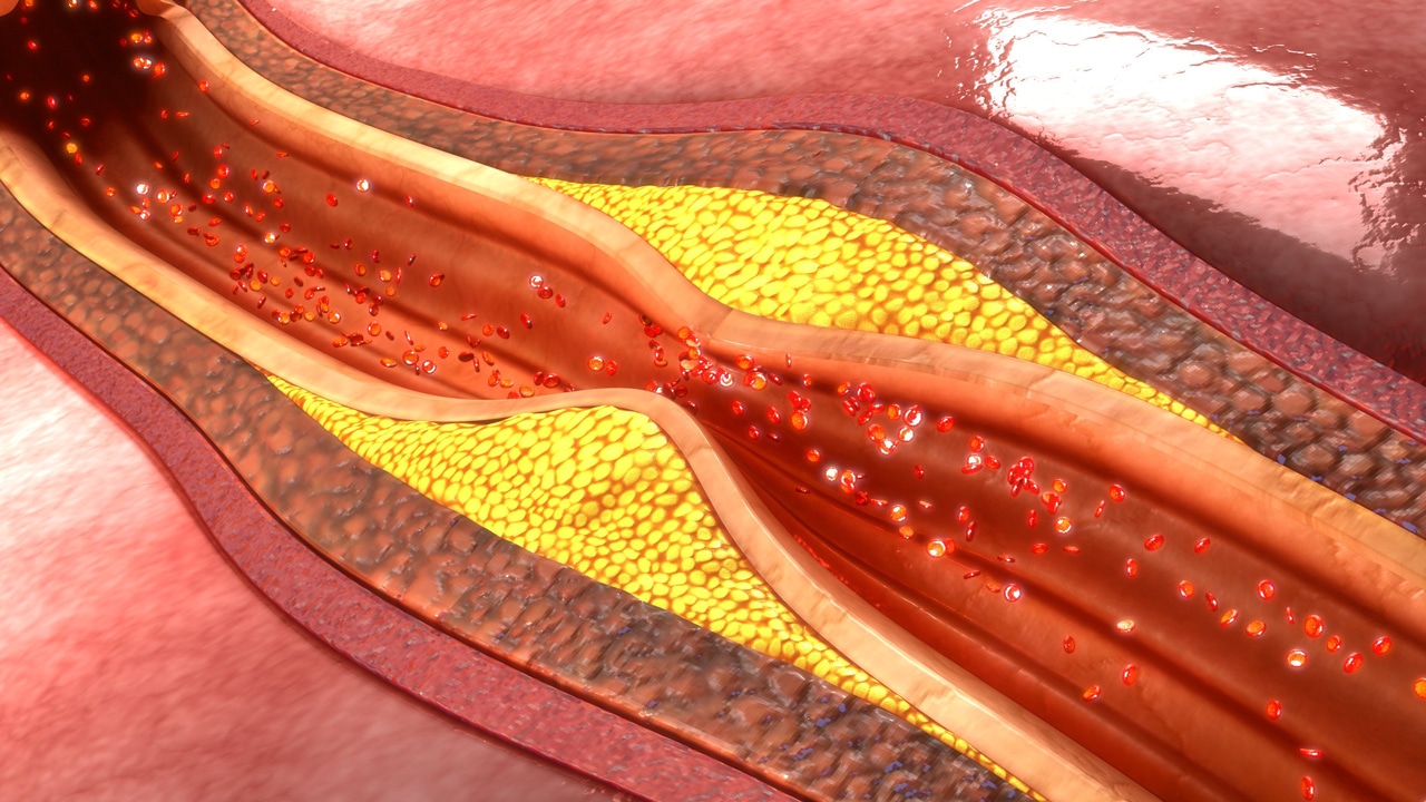 Featured image for “Cholesterinspiegel senken durch Heilfasten und Ernährung”