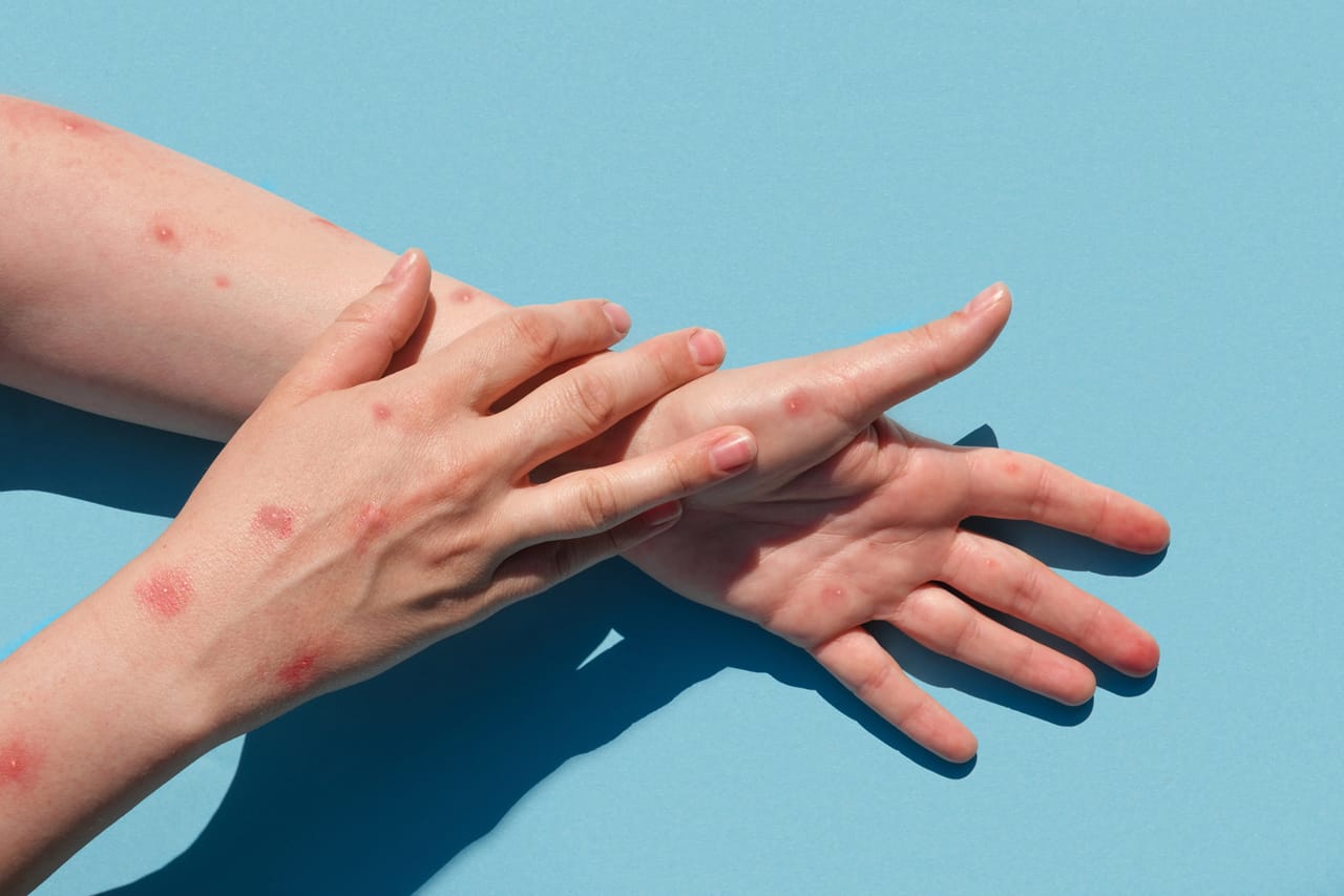 Featured image for “Affenpocken – Übertragung, Symptome & Gefährlichkeit”